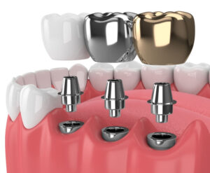 A Different Types of Dental Implants in S&C Dental at Scottsdale, AZ