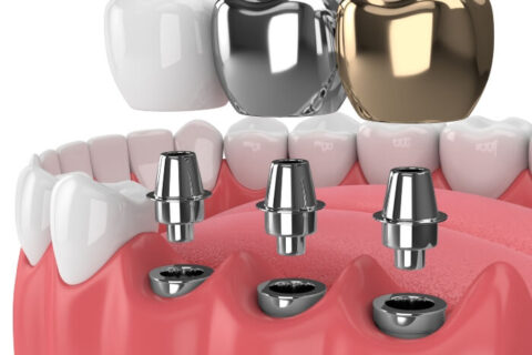 Different types pf screw type dental implantation by S&C dental,AZ