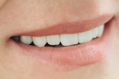 Female smile with zirconium artificial teeth