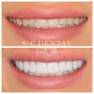 A Smile Comparison of Veneers at S&N dental.